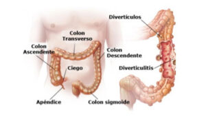 Negligencia médica al aplicar el procedijiento de proctoclisis a paciente con antecedente de diverticulitis 